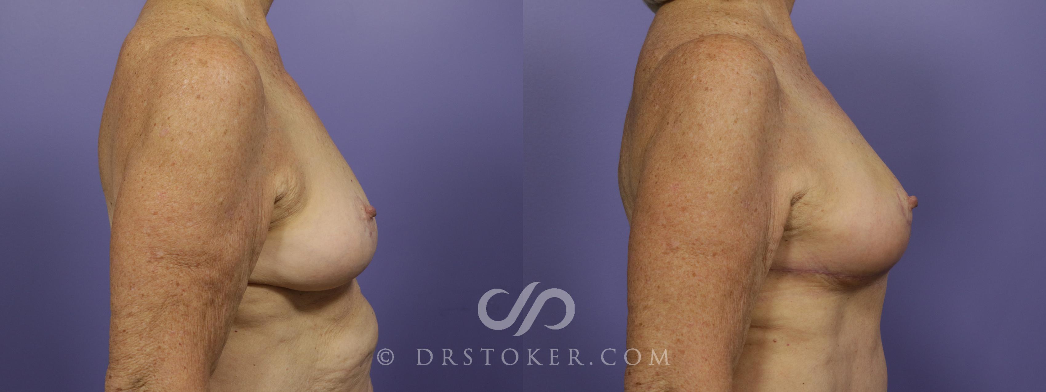 Before & After Breast Reduction (for Women) Case 1290 View #5 View in Los Angeles, CA