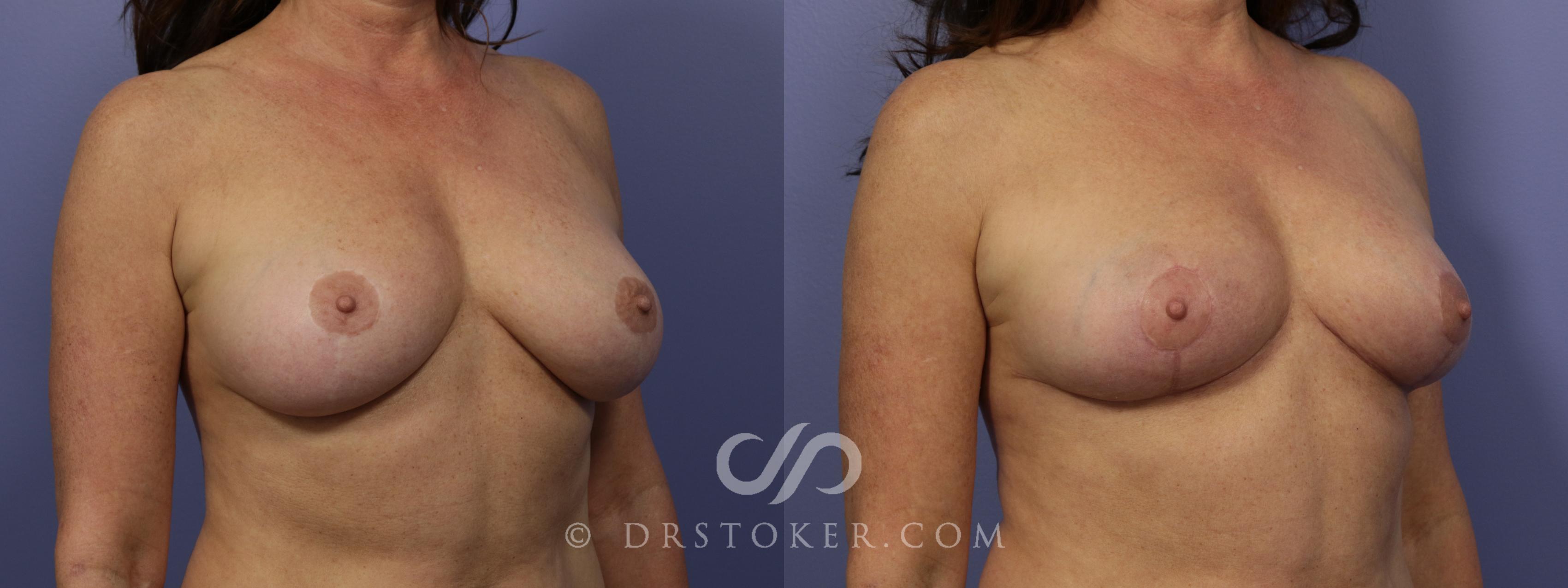 Before & After Breast Reduction (for Women) Case 1292 View #2 View in Los Angeles, CA