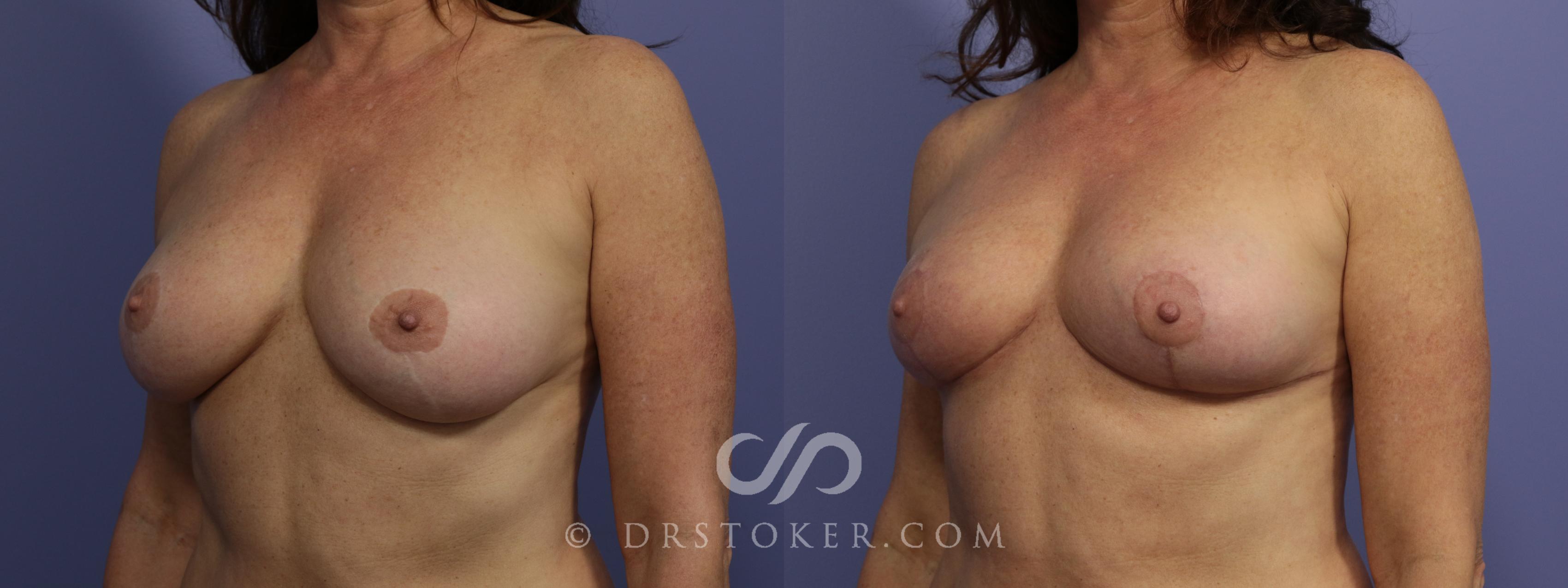 Before & After Breast Reduction (for Women) Case 1292 View #4 View in Los Angeles, CA