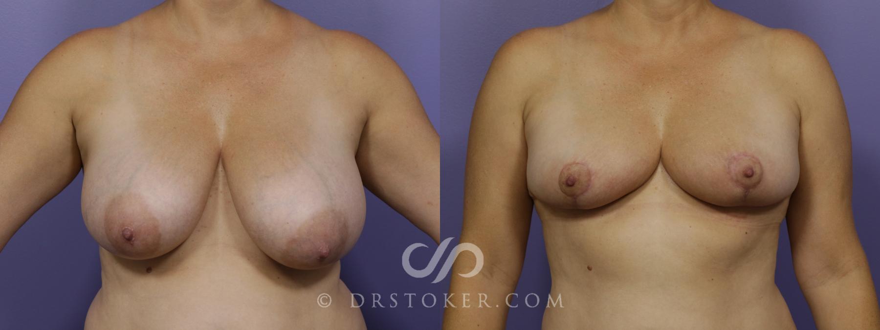 Before & After Breast Reduction (for Women) Case 1293 View #1 View in Los Angeles, CA
