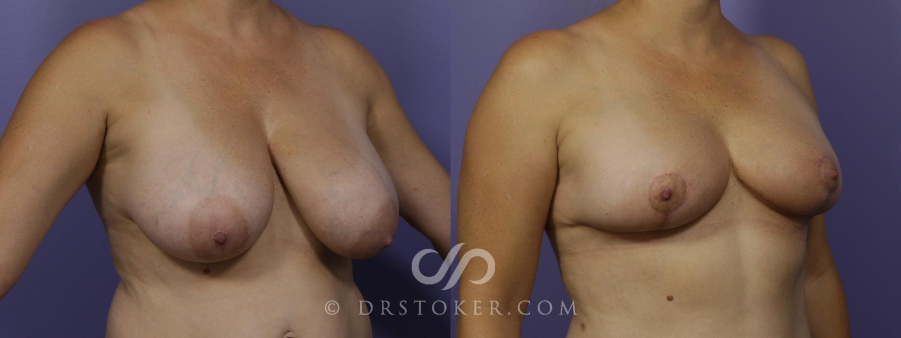 Before & After Breast Reduction (for Women) Case 1293 View #2 View in Los Angeles, CA