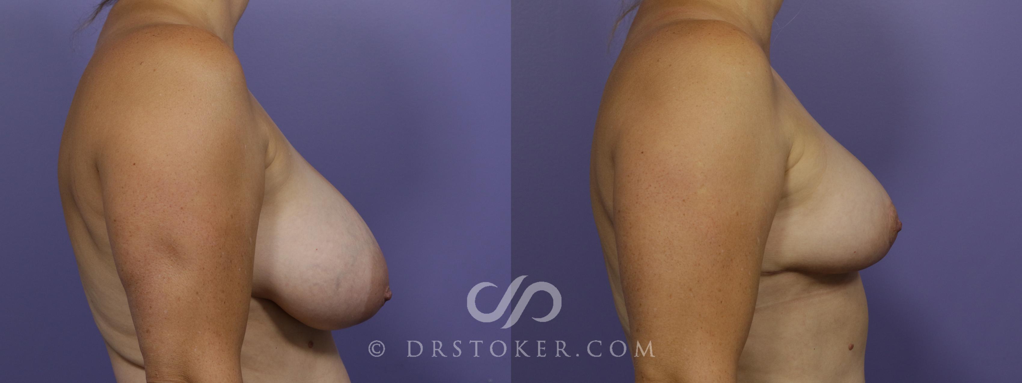 Before & After Breast Reduction (for Women) Case 1293 View #3 View in Los Angeles, CA