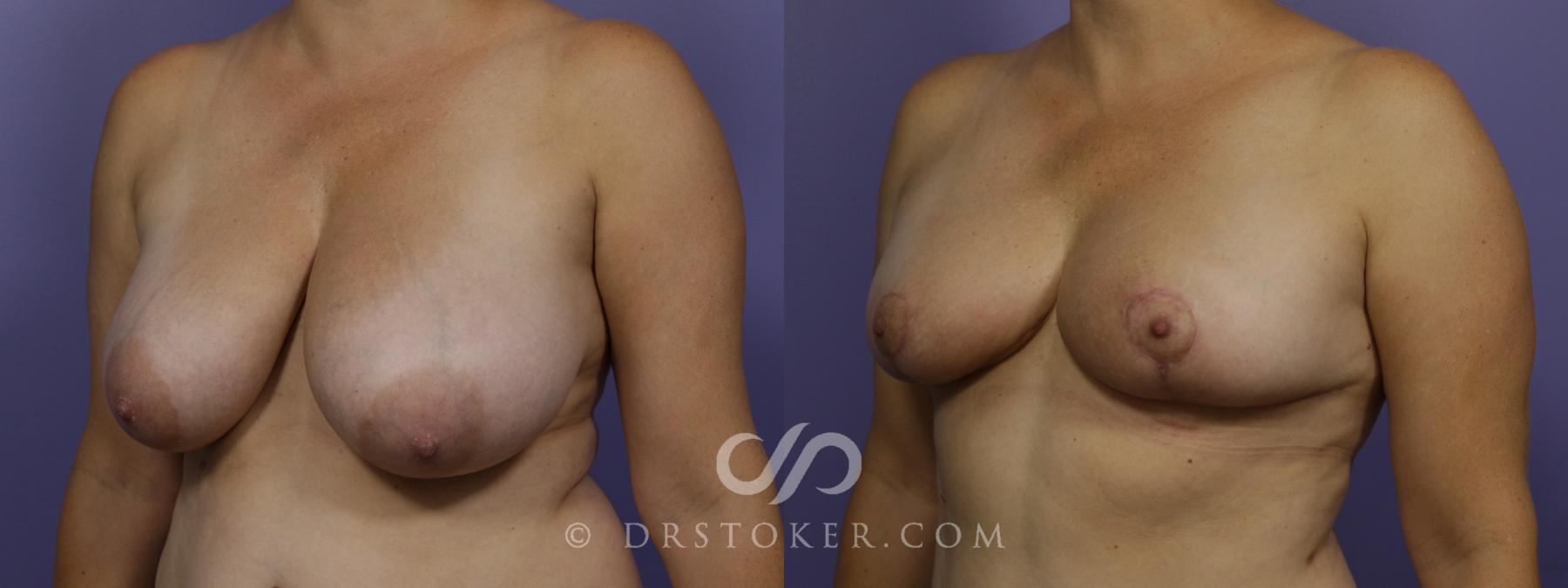 Before & After Breast Reduction (for Women) Case 1293 View #4 View in Los Angeles, CA