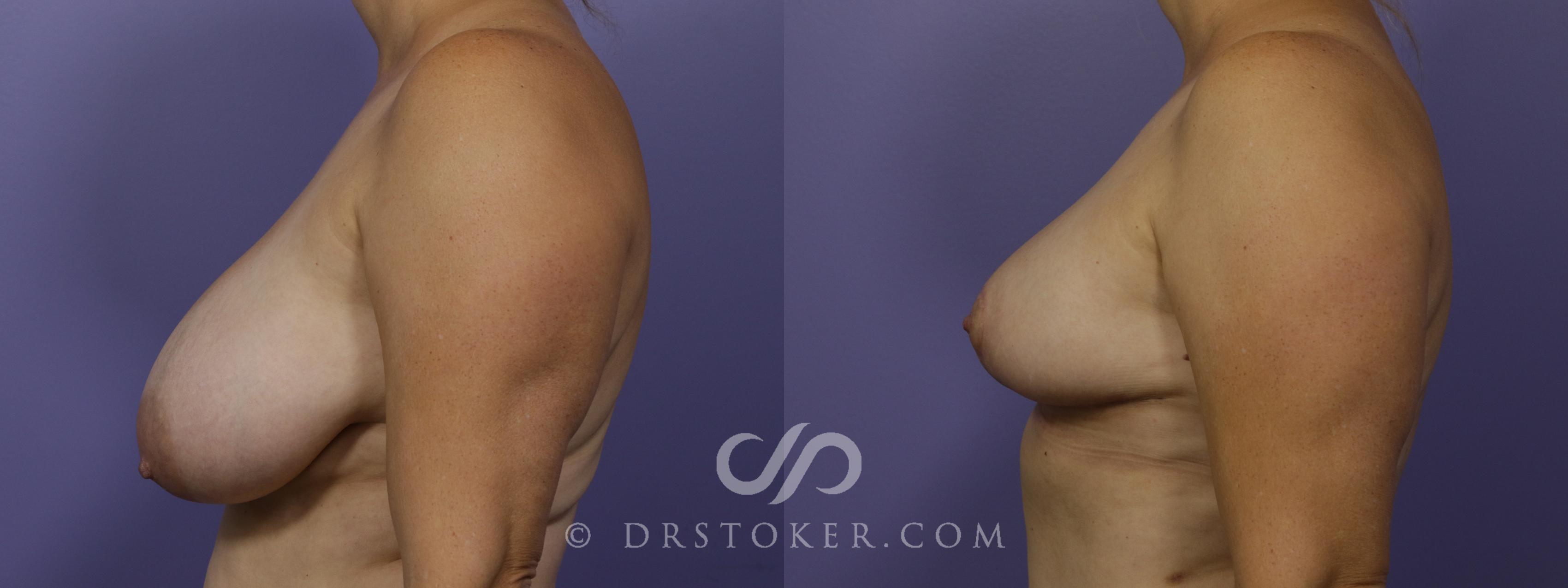 Before & After Breast Reduction (for Women) Case 1293 View #5 View in Los Angeles, CA