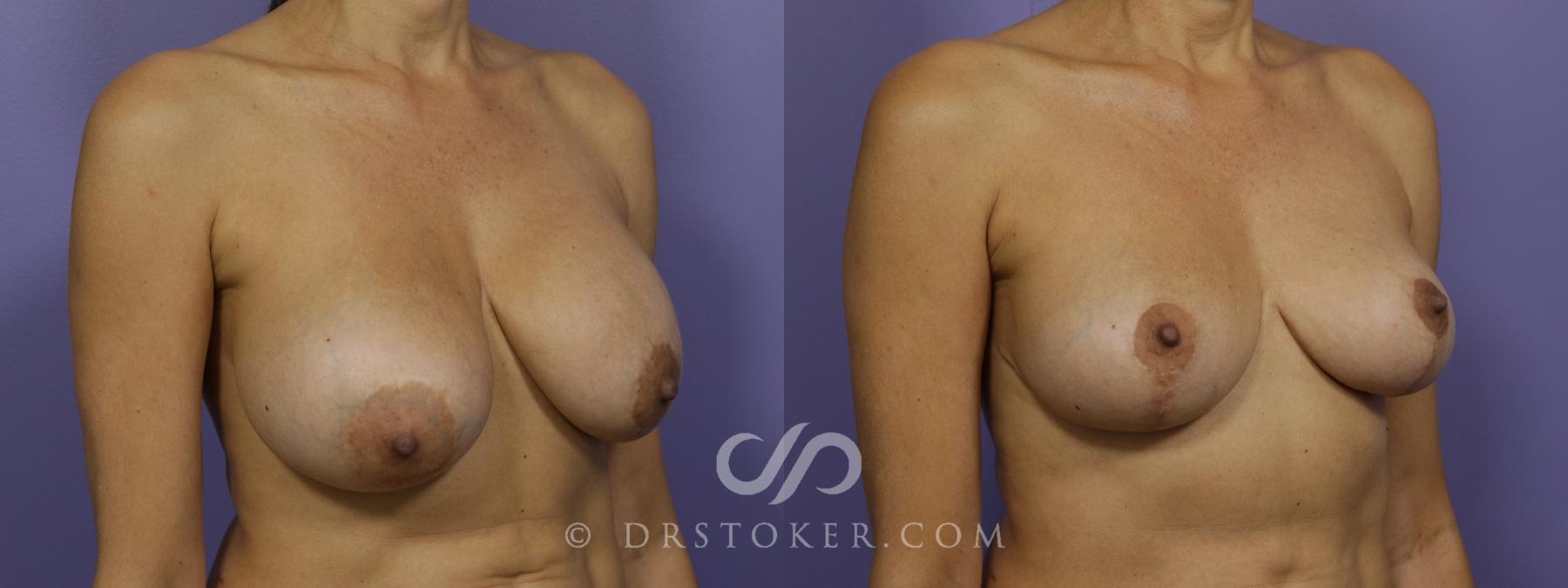 Before & After Breast Reduction (for Women) Case 1294 View #2 View in Los Angeles, CA