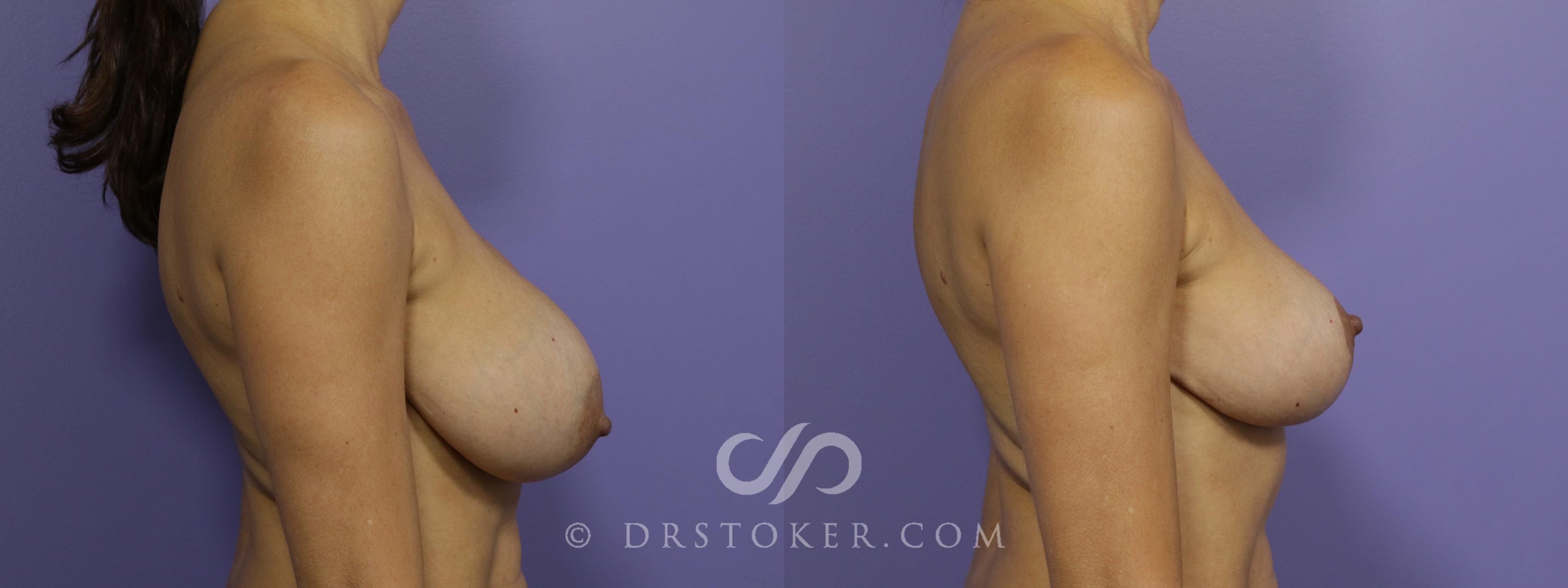 Before & After Breast Reduction (for Women) Case 1294 View #3 View in Los Angeles, CA