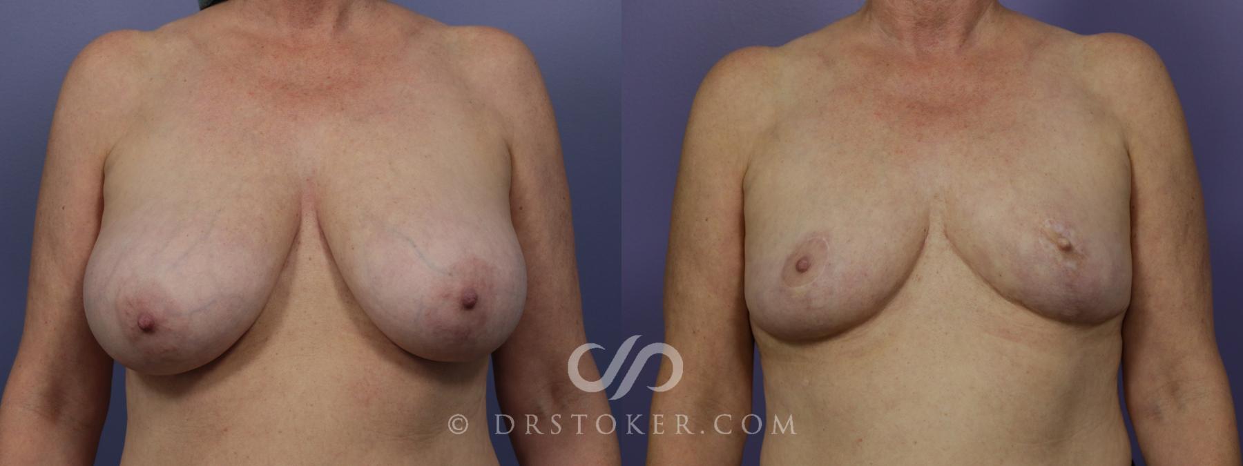 Before & After Breast Reduction (for Women) Case 1295 View #1 View in Los Angeles, CA