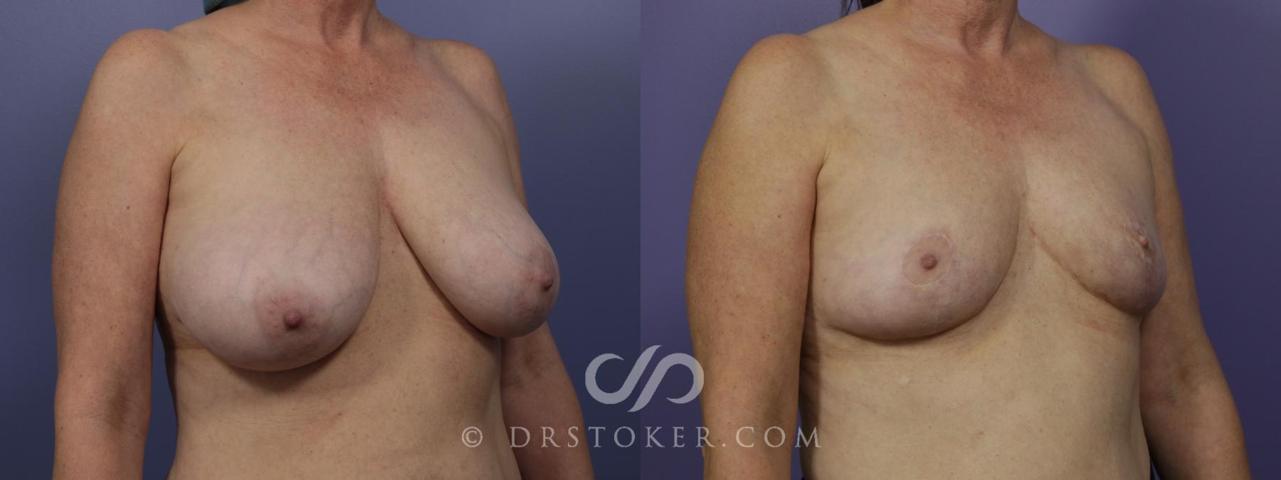Before & After Breast Reduction (for Women) Case 1295 View #2 View in Los Angeles, CA