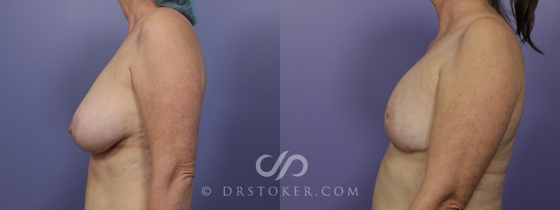 Before & After Breast Reduction (for Women) Case 1295 View #3 View in Los Angeles, CA
