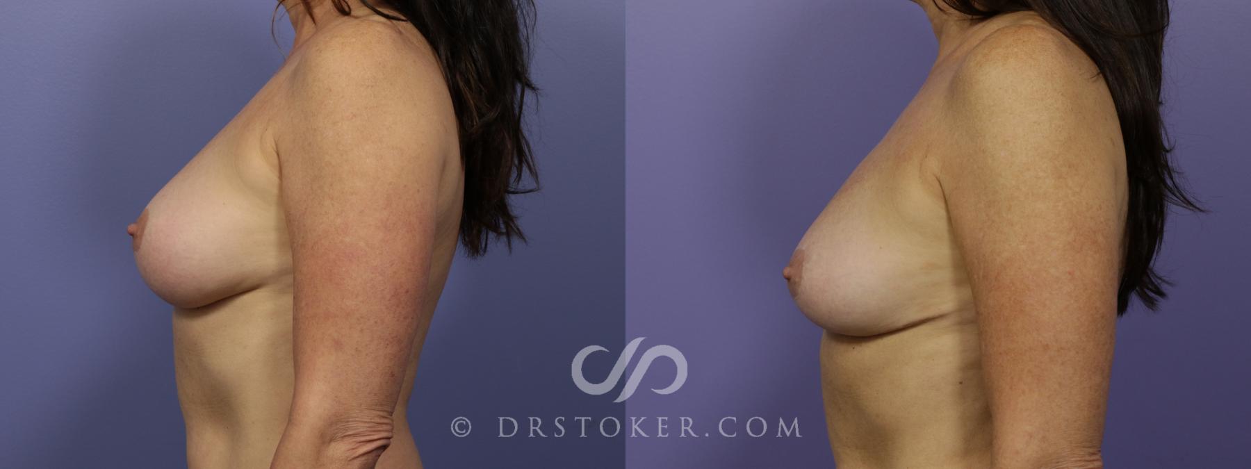 Before & After Breast Reduction (for Women) Case 1413 View #4 View in Los Angeles, CA