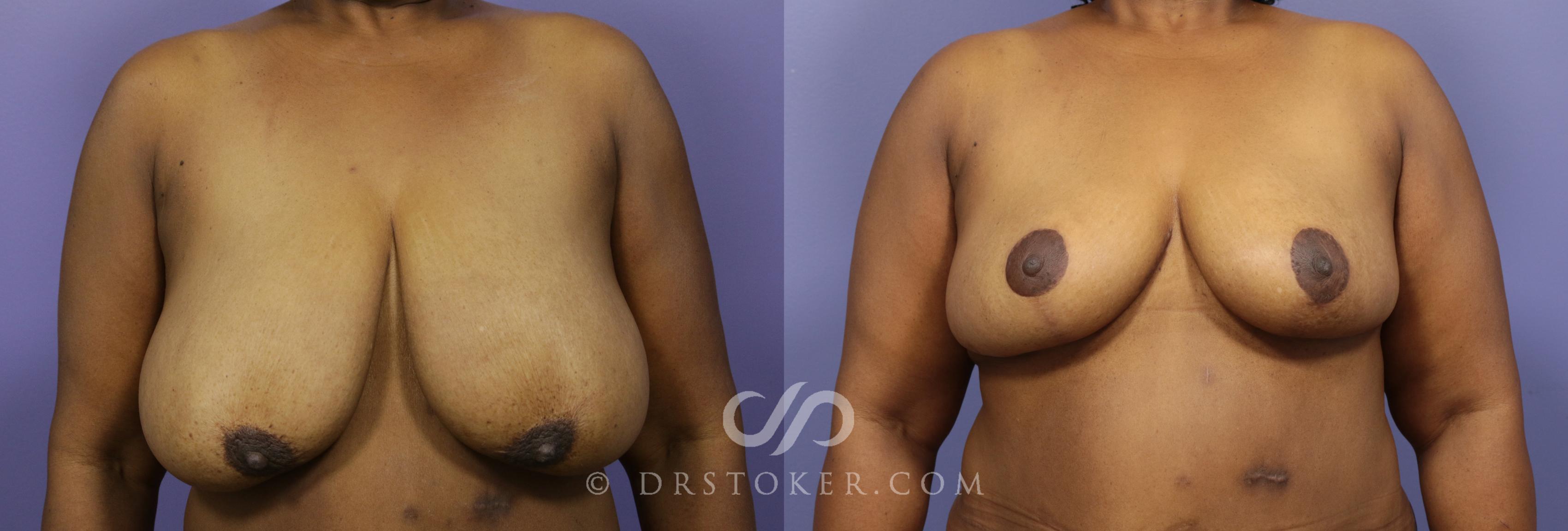 Before & After Breast Reduction (for Women) Case 1414 View #1 View in Los Angeles, CA
