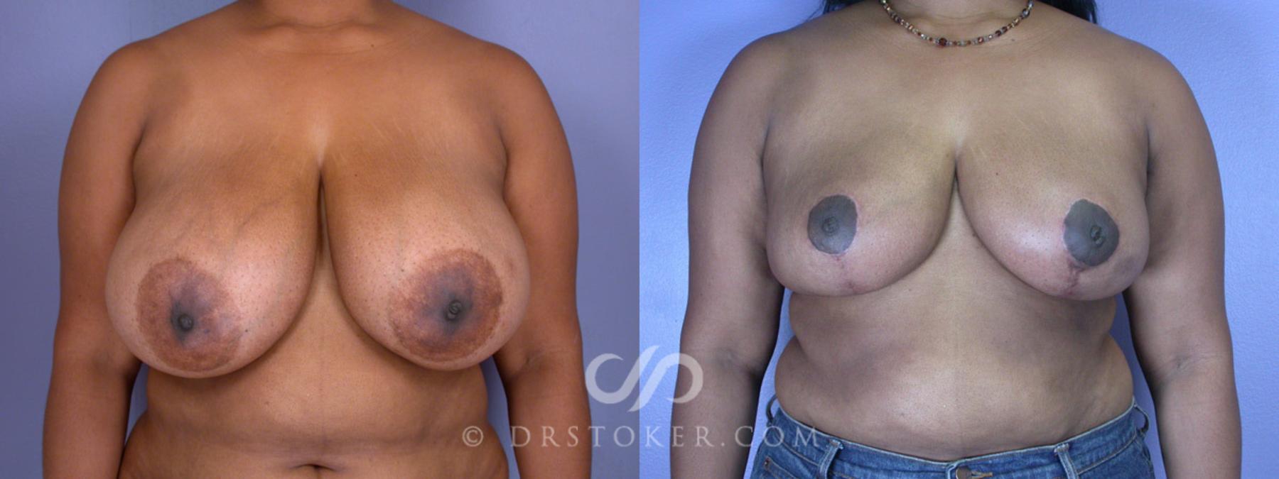 Before & After Breast Reduction (for Women) Case 202 View #1 View in Los Angeles, CA