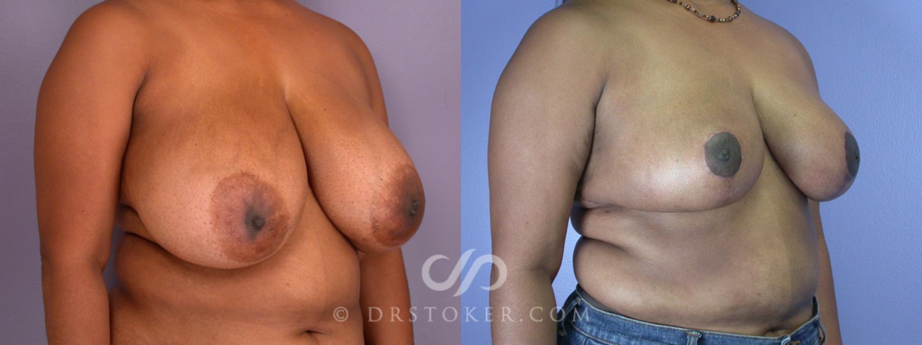 Before & After Breast Reduction (for Women) Case 202 View #2 View in Los Angeles, CA