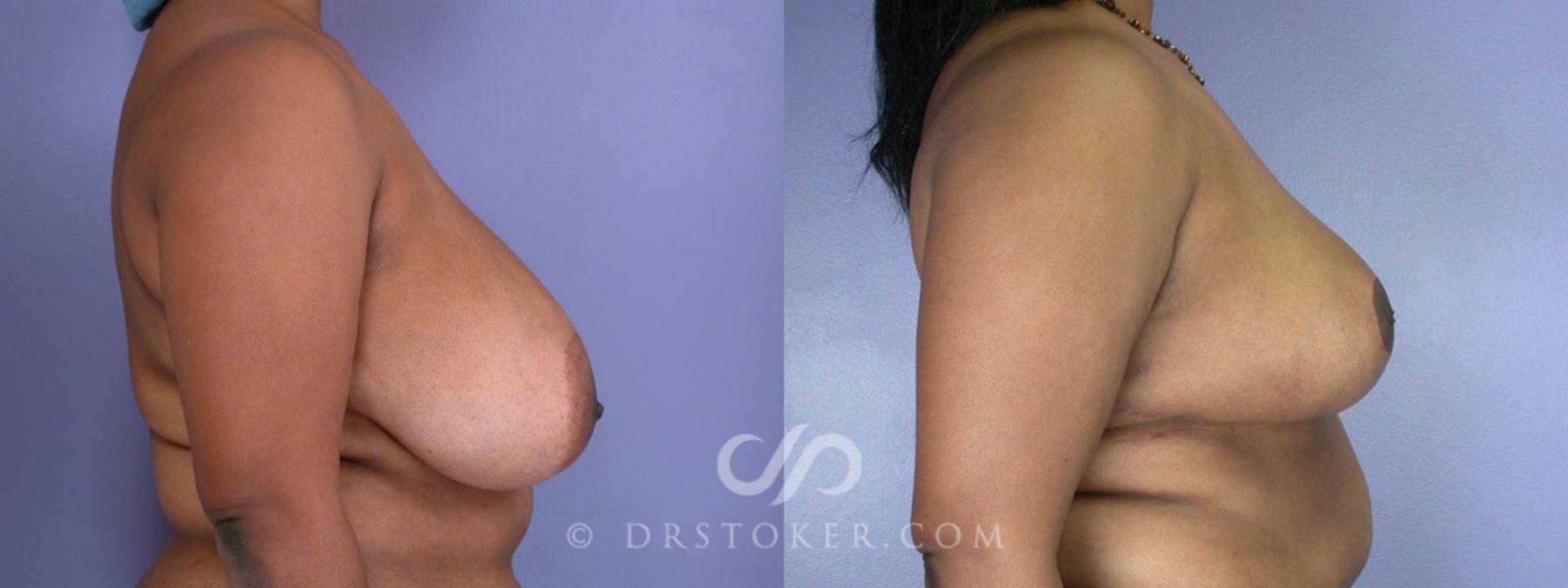 Before & After Breast Reduction (for Women) Case 202 View #3 View in Los Angeles, CA