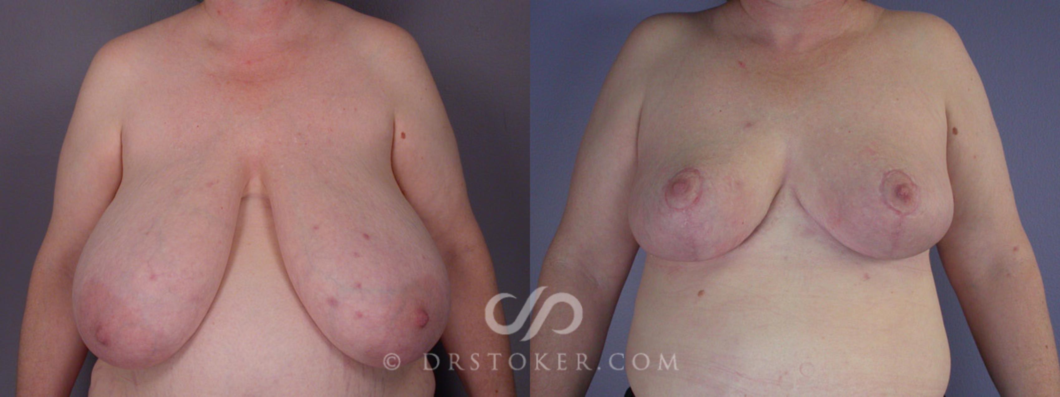 Before & After Breast Reduction (for Women) Case 203 View #1 View in Los Angeles, CA