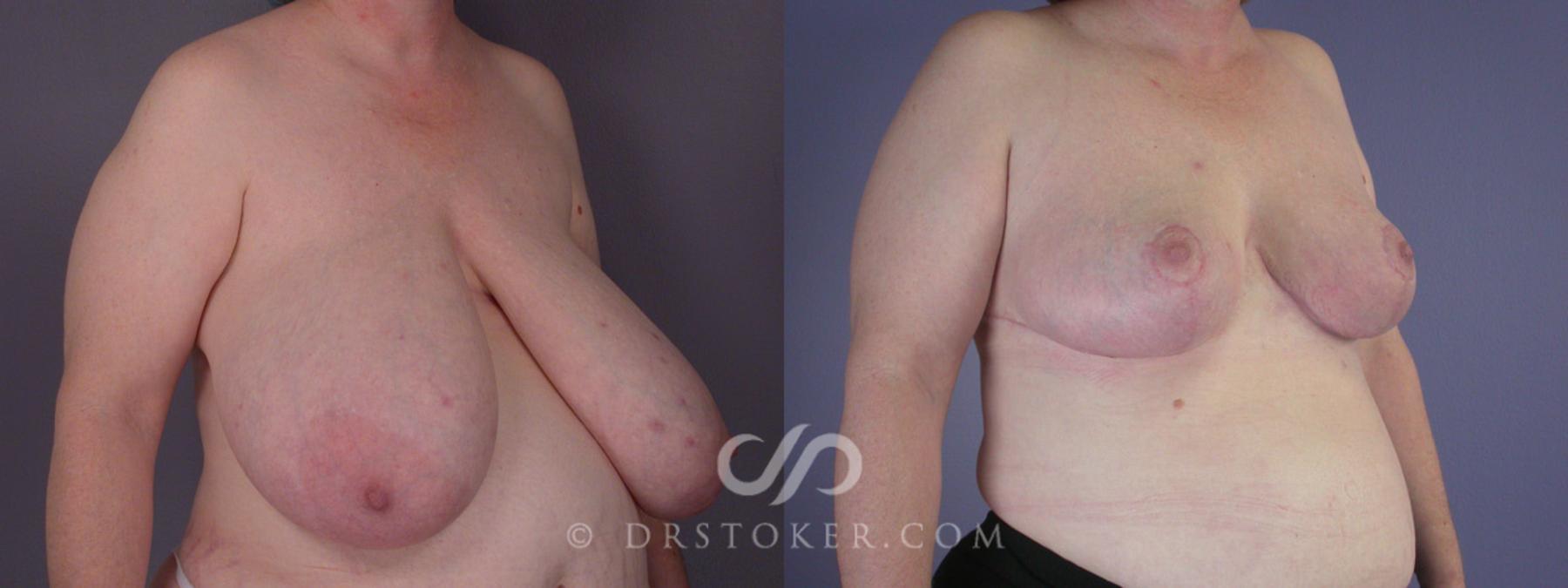Before & After Breast Reduction (for Women) Case 203 View #2 View in Los Angeles, CA