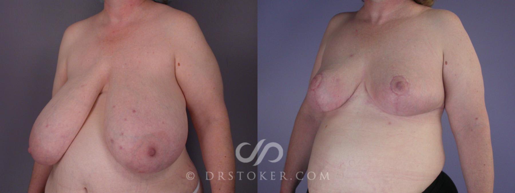 Before & After Breast Reduction (for Women) Case 203 View #3 View in Los Angeles, CA