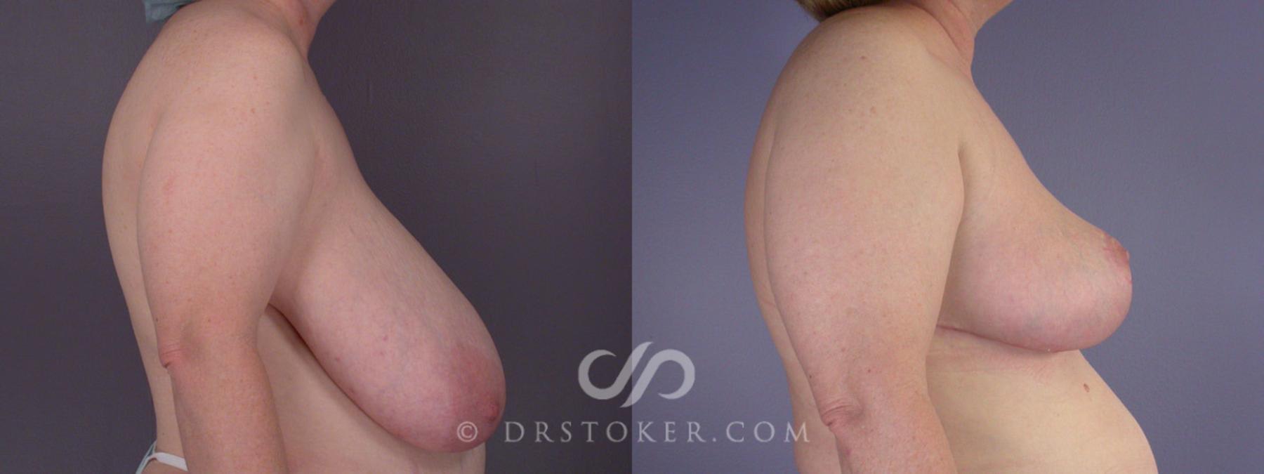 Before & After Breast Reduction (for Women) Case 203 View #4 View in Los Angeles, CA