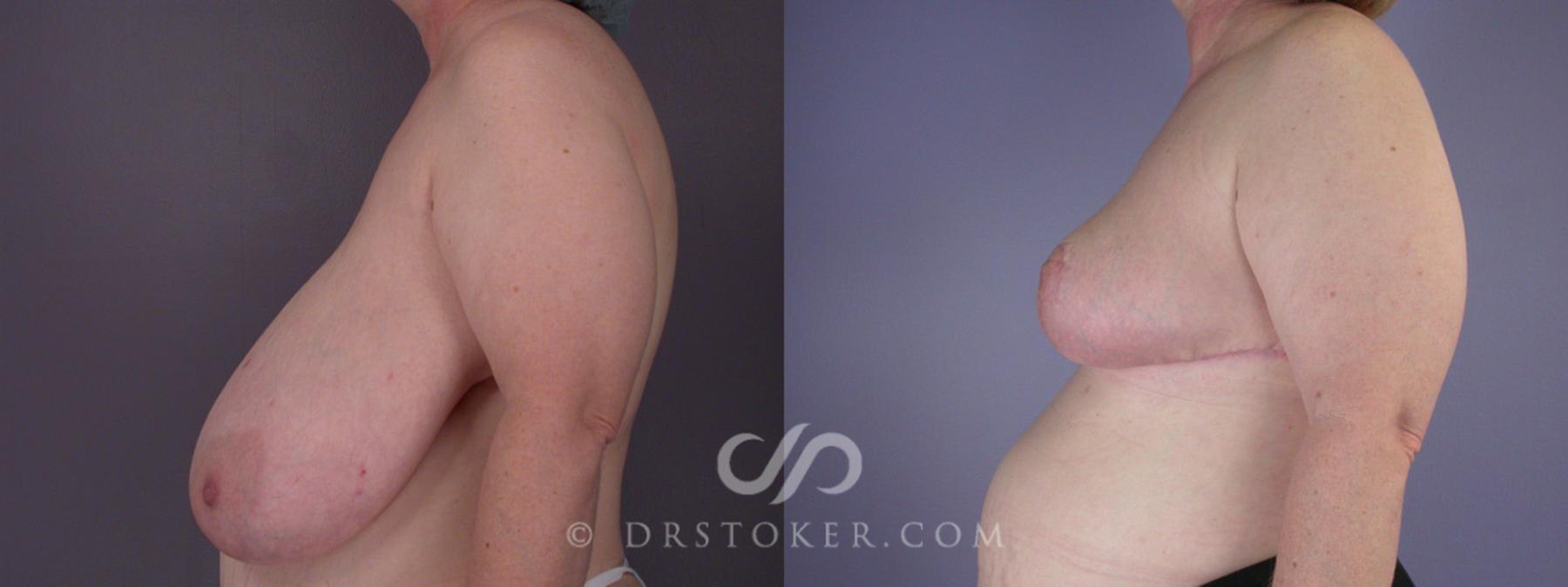 Before & After Breast Reduction (for Women) Case 203 View #5 View in Los Angeles, CA