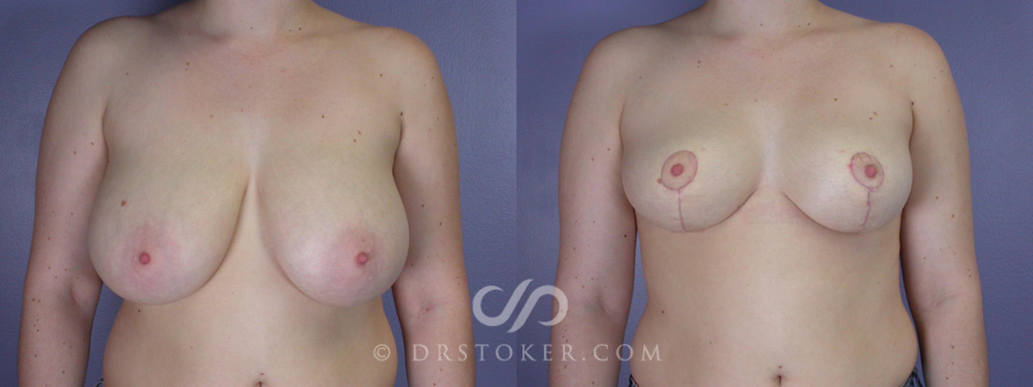 Before & After Breast Reduction (for Women) Case 204 View #1 View in Los Angeles, CA