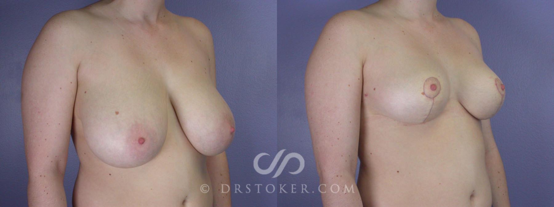 Before & After Breast Reduction (for Women) Case 204 View #2 View in Los Angeles, CA
