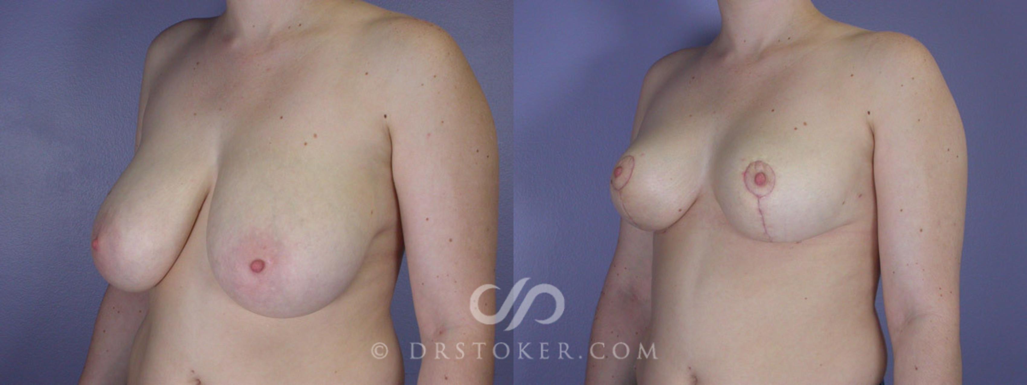 Before & After Breast Reduction (for Women) Case 204 View #3 View in Los Angeles, CA