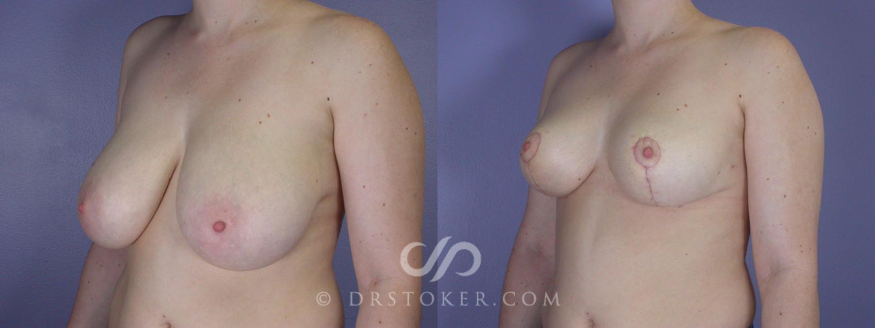 Before & After Breast Reduction (for Women) Case 204 View #3 View in Los Angeles, CA