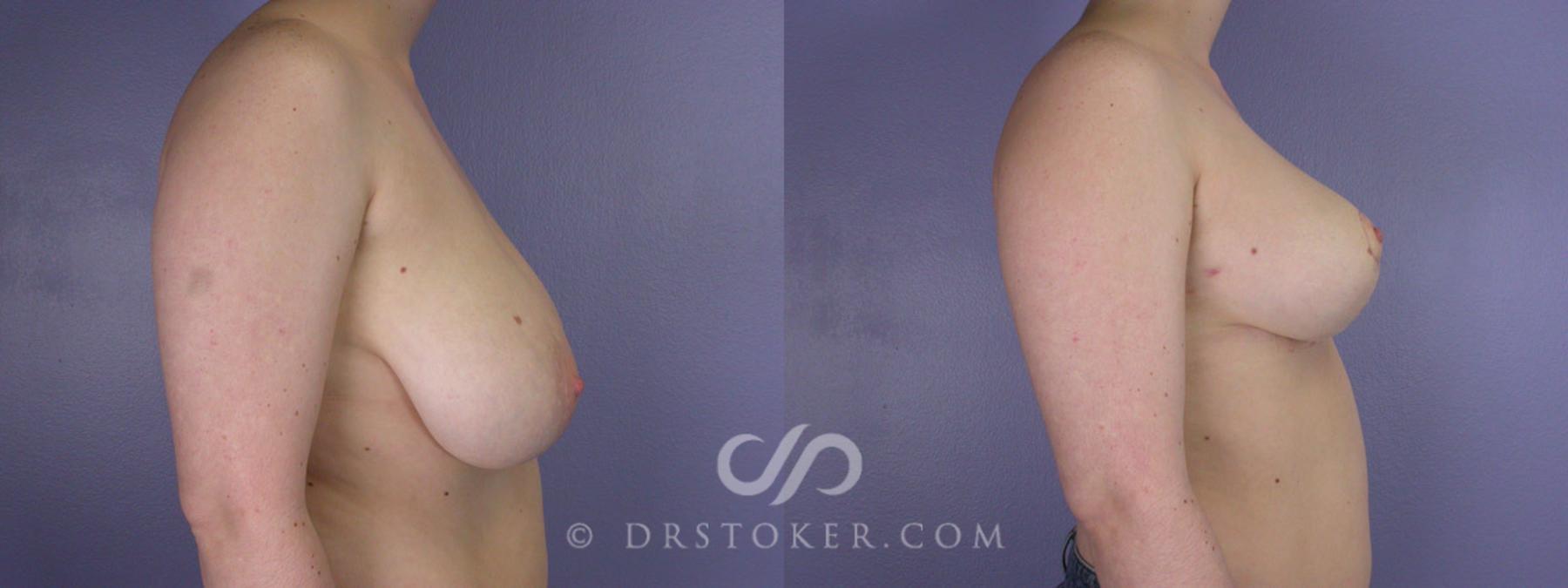 Before & After Breast Reduction (for Women) Case 204 View #4 View in Los Angeles, CA