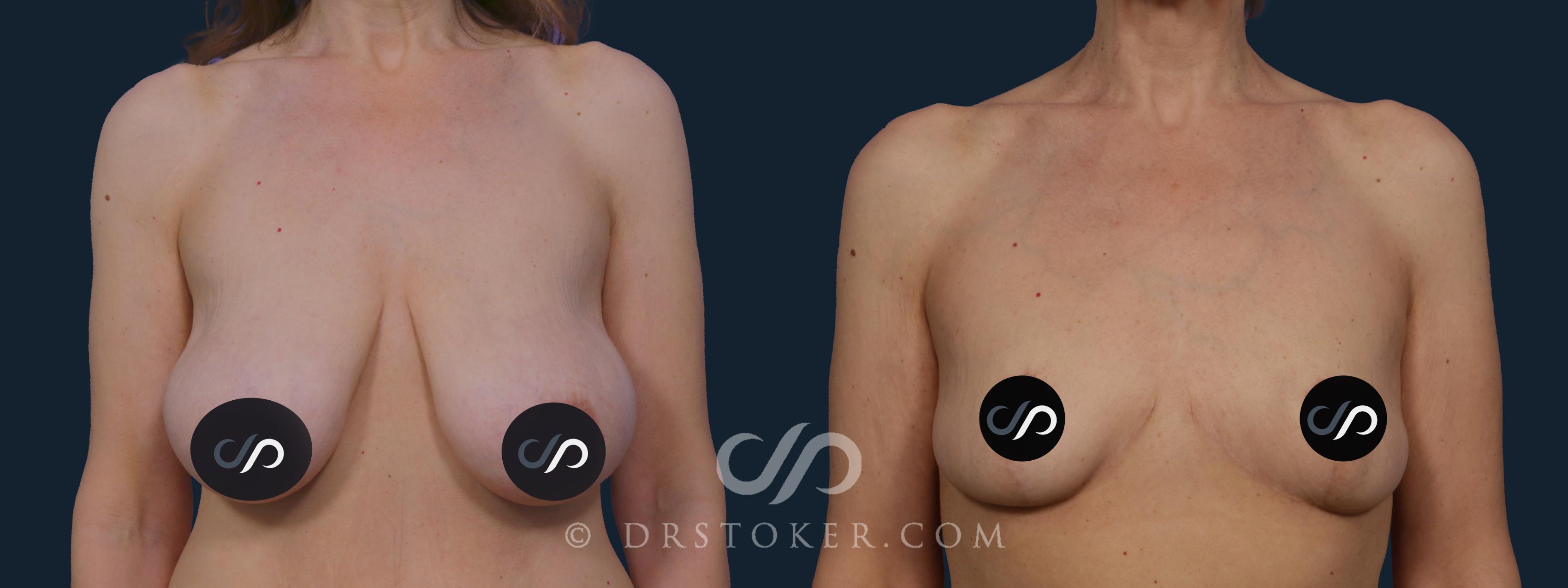 Before & After Breast Reduction (for Women) Case 2042 Front View in Los Angeles, CA