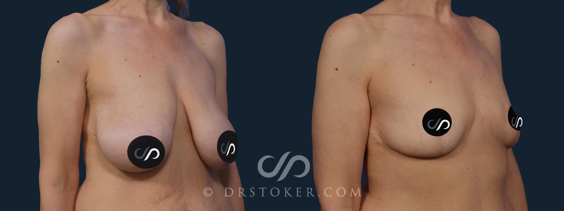 Before & After Breast Reduction (for Women) Case 2042 Right Oblique View in Los Angeles, CA