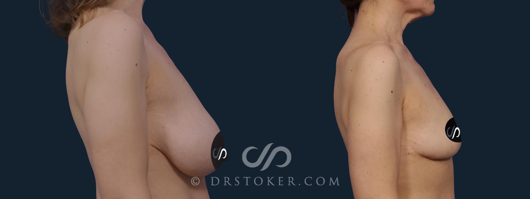 Before & After Breast Reduction (for Women) Case 2042 Right Side View in Los Angeles, CA