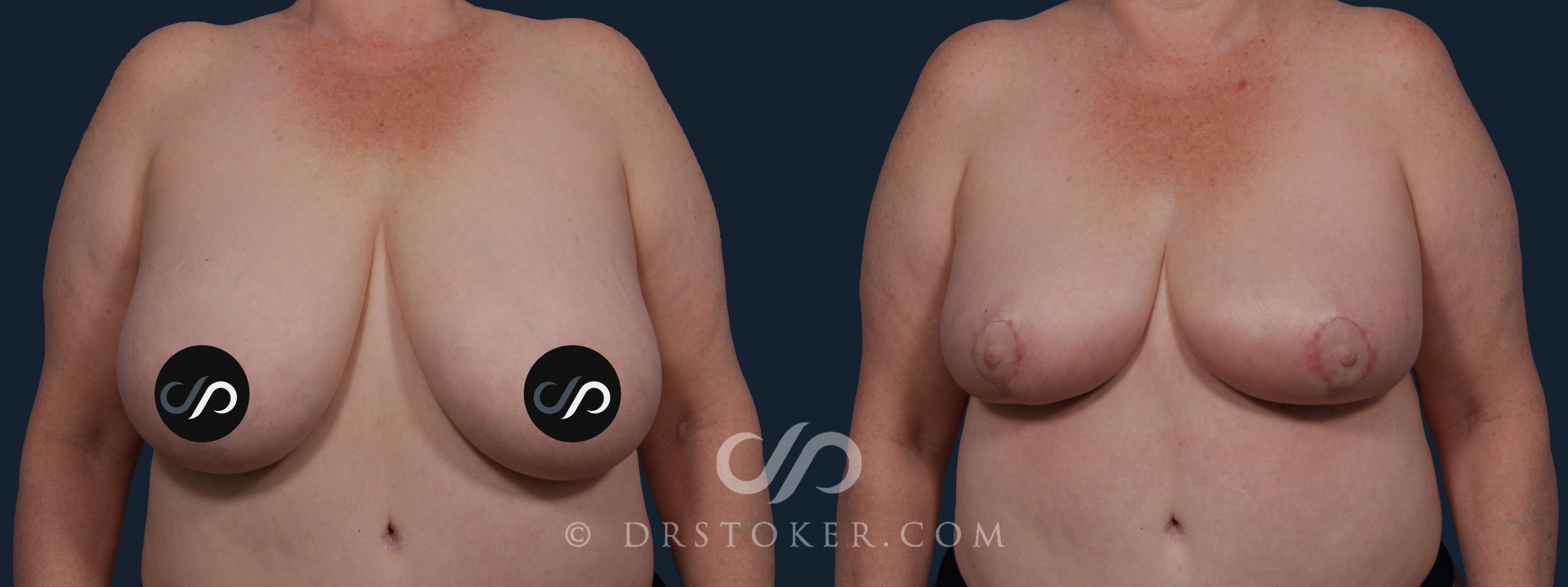 Before & After Breast Reduction (for Women) Case 2044 Front View in Los Angeles, CA