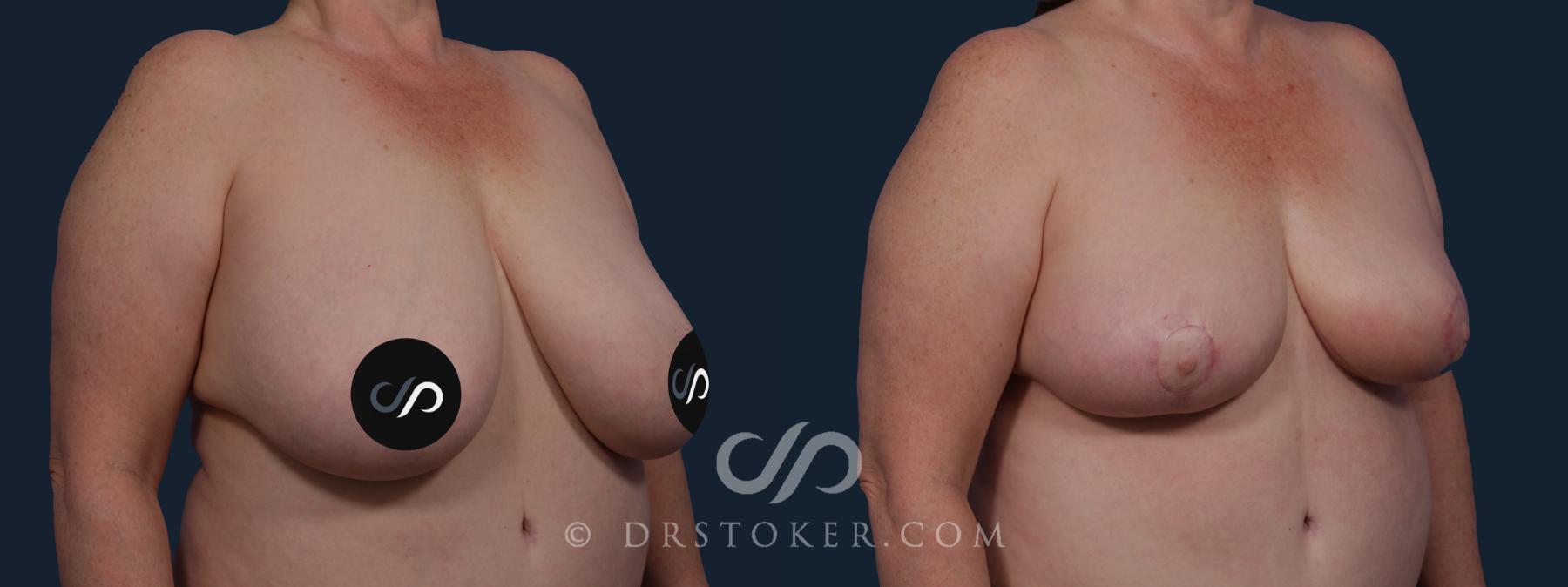 Before & After Breast Reduction (for Women) Case 2044 Right Oblique View in Los Angeles, CA
