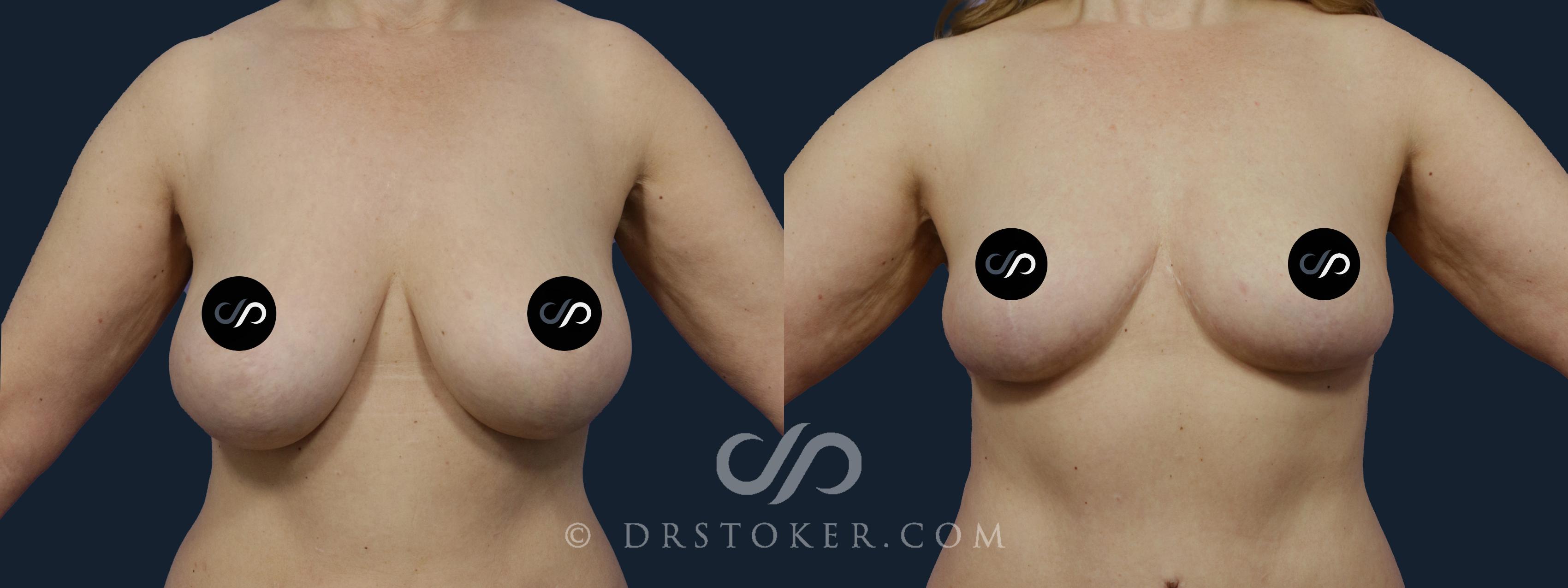 Before & After Breast Reduction (for Women) Case 2047 Front View in Los Angeles, CA