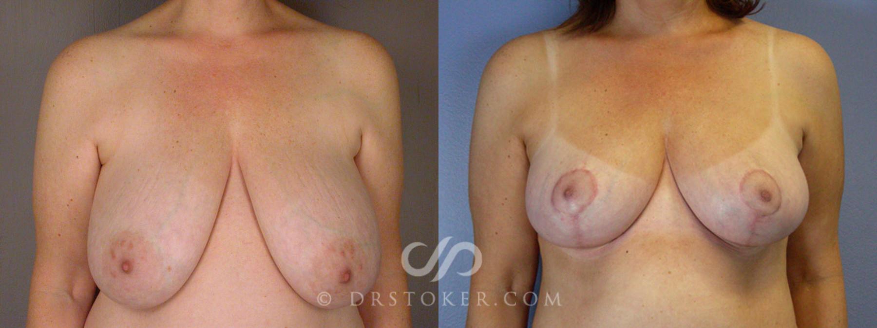 Before & After Breast Reduction (for Women) Case 205 View #1 View in Los Angeles, CA
