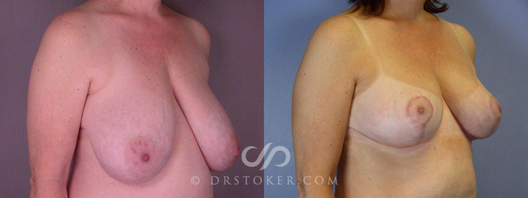Before & After Breast Reduction (for Women) Case 205 View #2 View in Los Angeles, CA