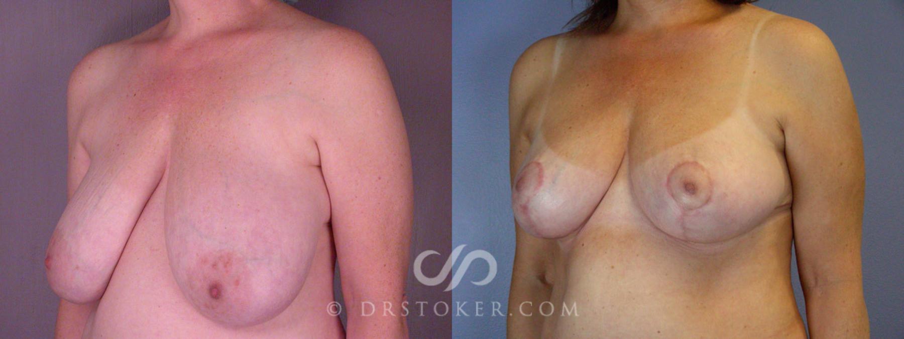 Before & After Breast Reduction (for Women) Case 205 View #3 View in Los Angeles, CA