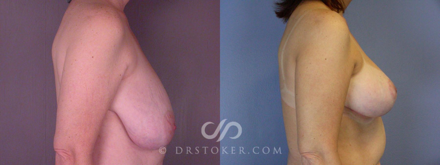 Before & After Breast Reduction (for Women) Case 205 View #4 View in Los Angeles, CA