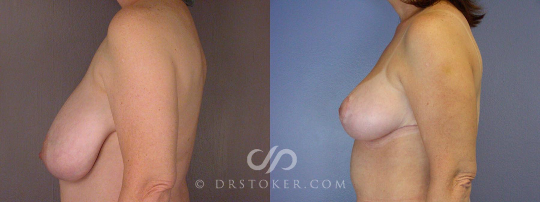 Before & After Breast Reduction (for Women) Case 205 View #5 View in Los Angeles, CA