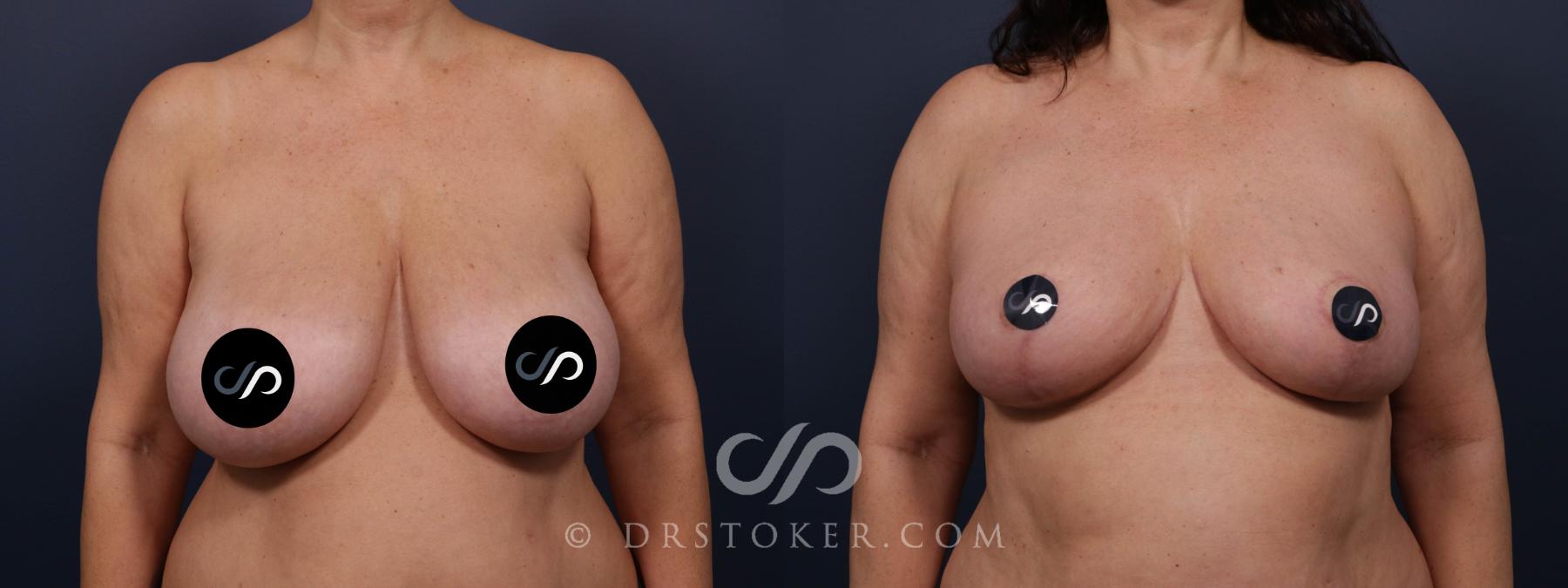 Before & After Breast Lift Case 2051 Front View in Los Angeles, CA