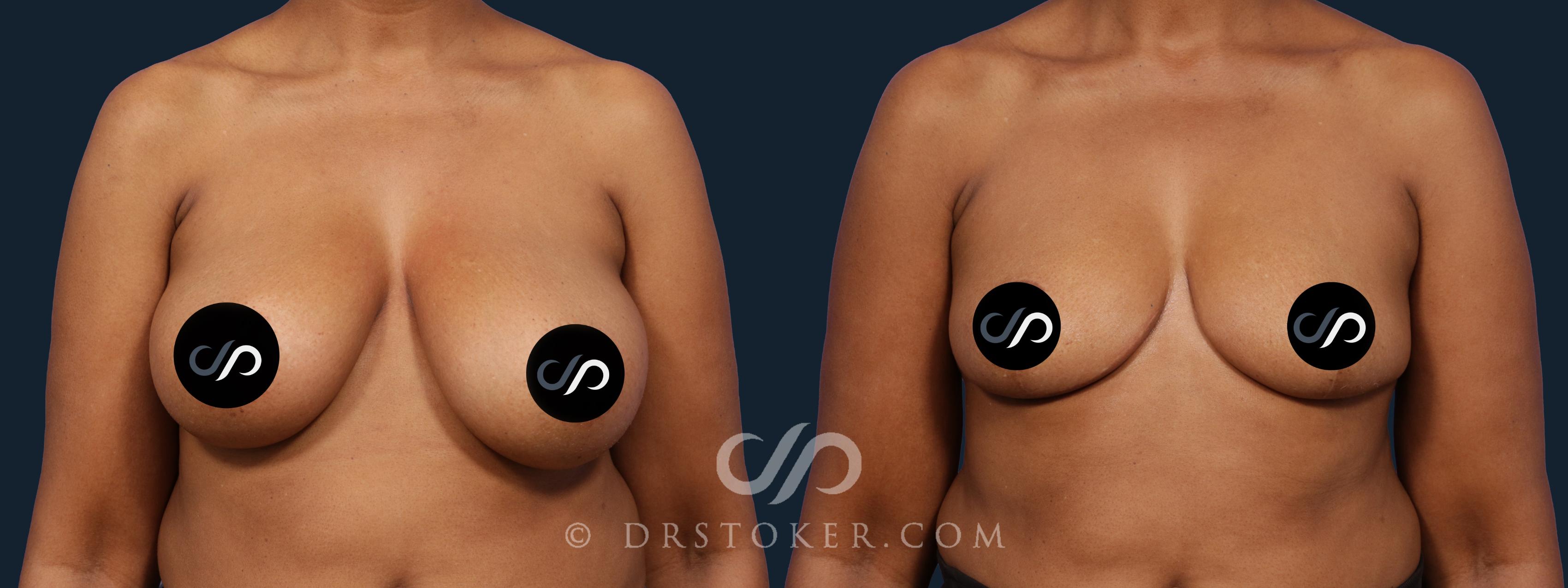 Before & After Breast Reduction (for Women) Case 2057 Front View in Los Angeles, CA
