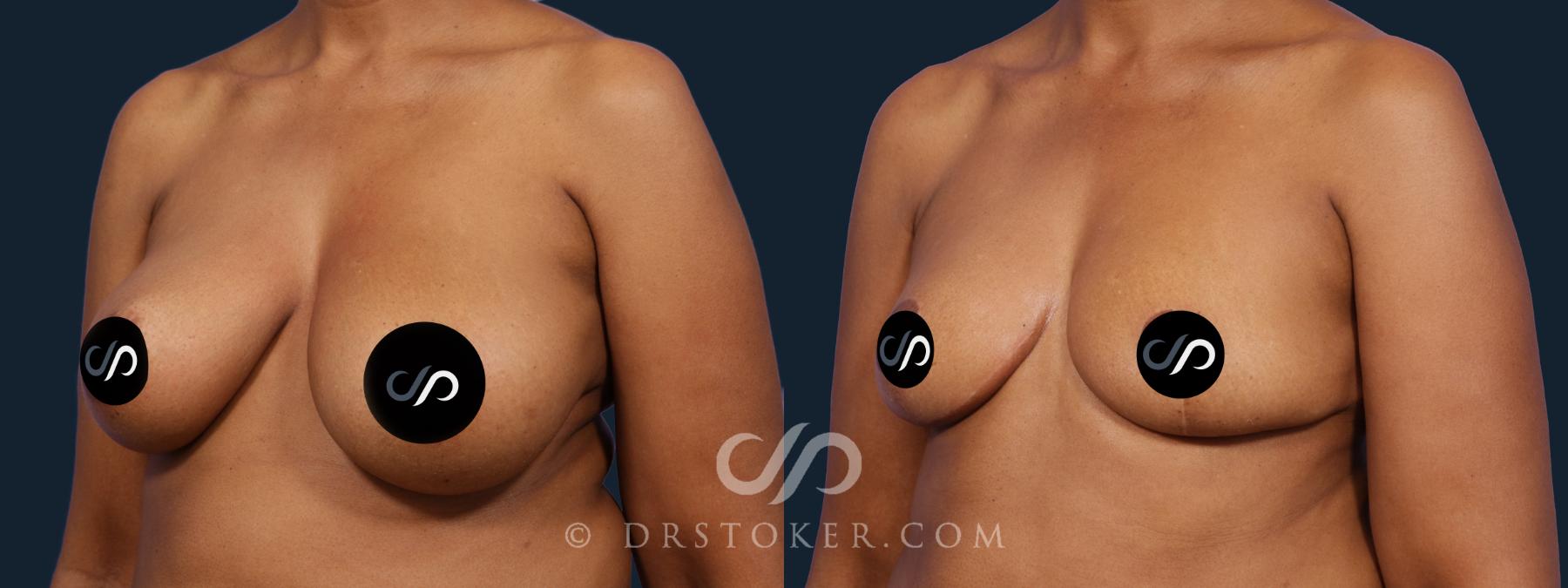 Before & After Breast Reduction (for Women) Case 2057 Left Oblique View in Los Angeles, CA