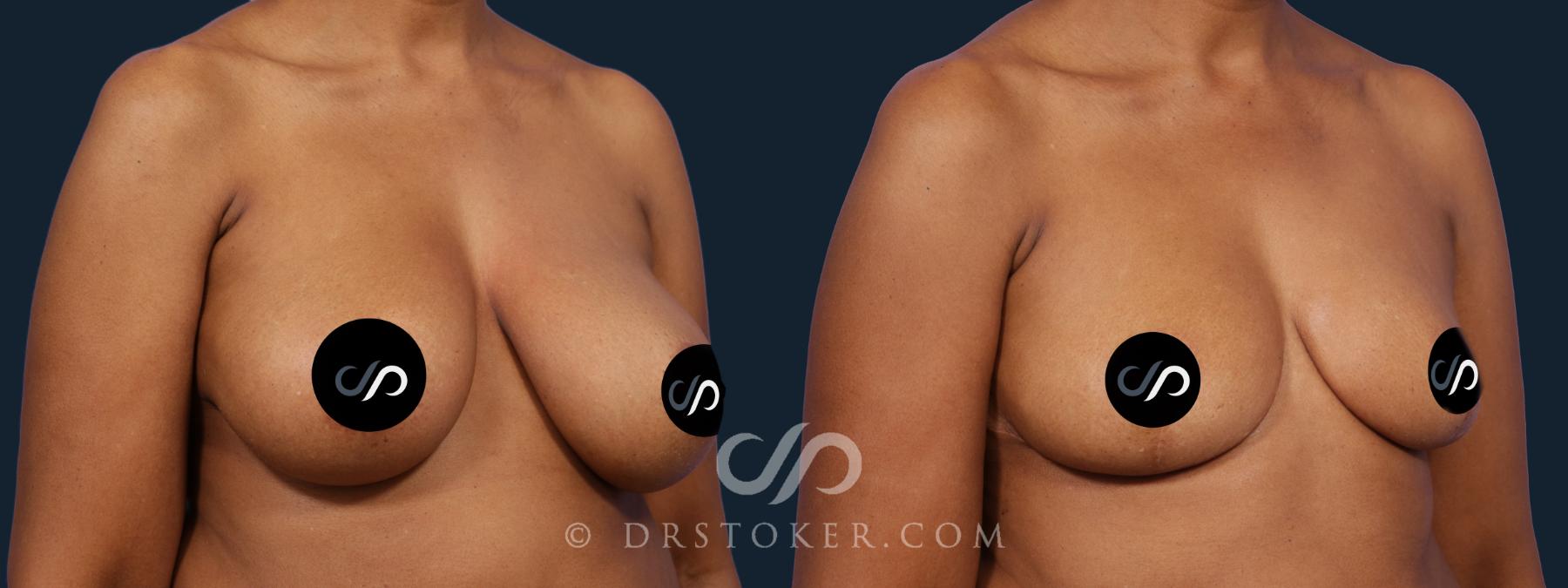 Before & After Breast Reduction (for Women) Case 2057 Right Oblique View in Los Angeles, CA