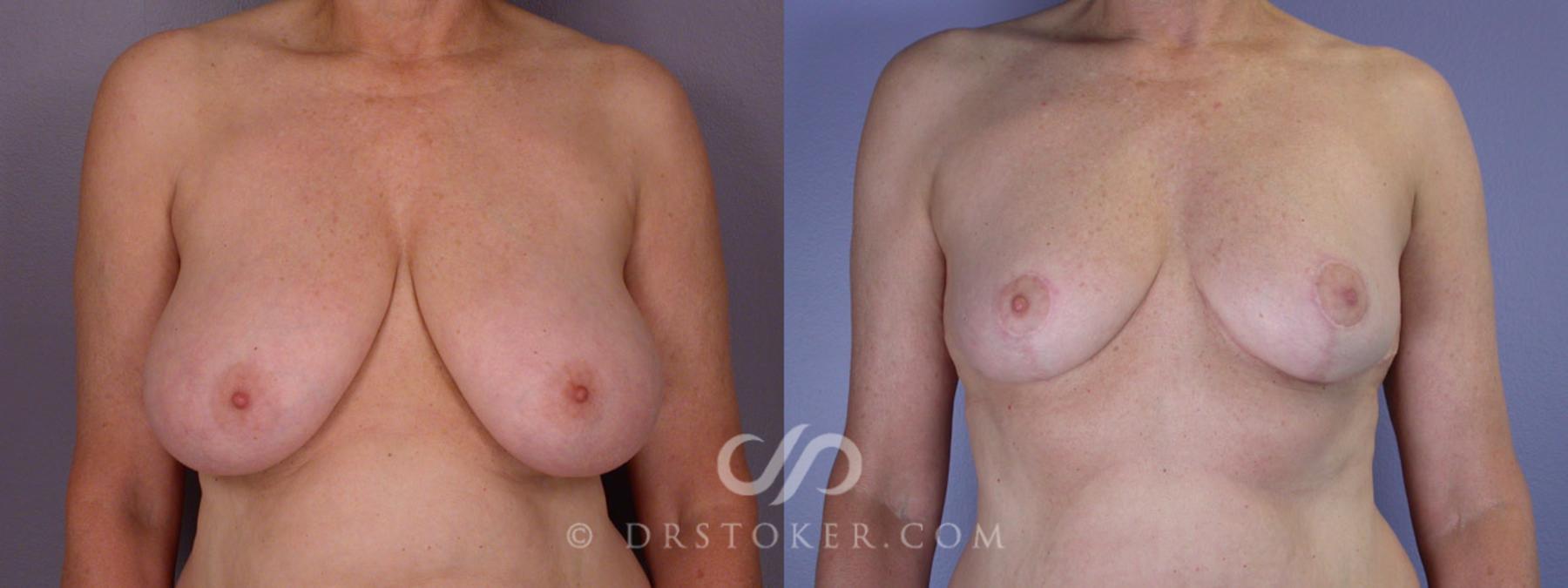 Before & After Breast Reduction (for Women) Case 206 View #1 View in Los Angeles, CA