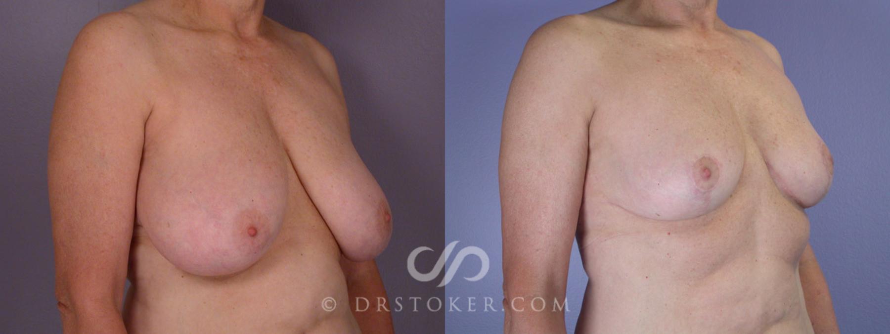 Before & After Breast Reduction (for Women) Case 206 View #2 View in Los Angeles, CA