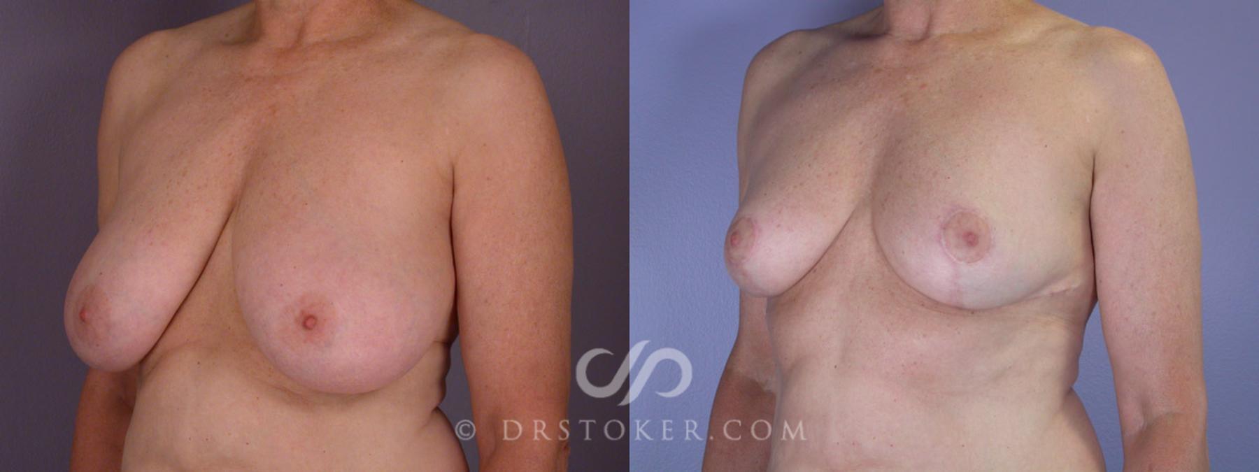 Before & After Breast Reduction (for Women) Case 206 View #3 View in Los Angeles, CA