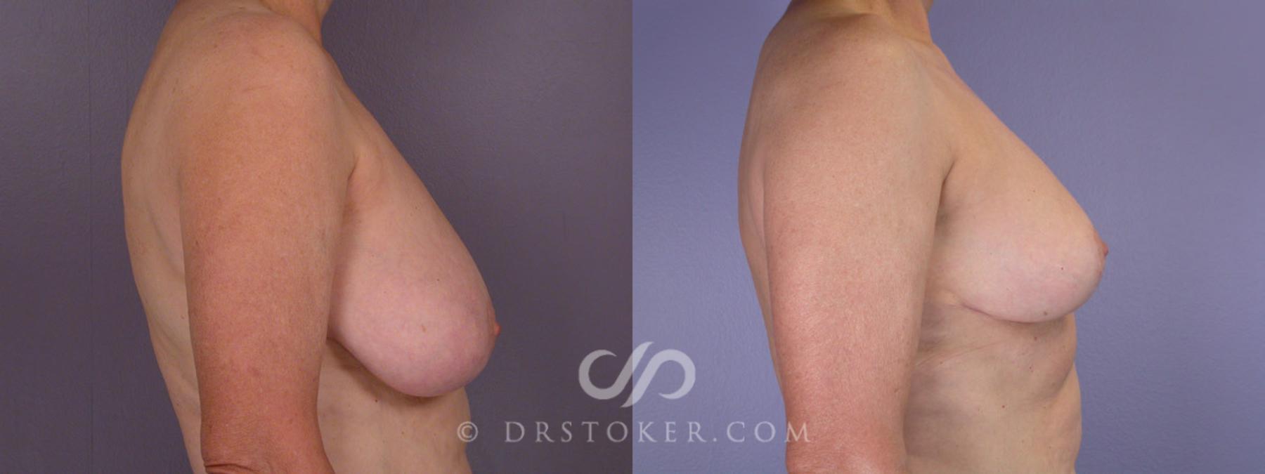 Before & After Breast Reduction (for Women) Case 206 View #4 View in Los Angeles, CA