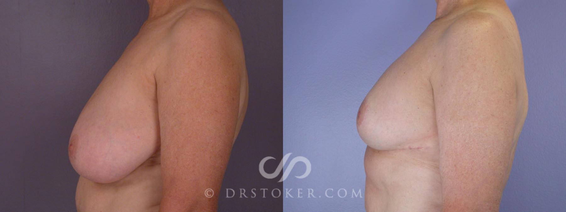 Before & After Breast Reduction (for Women) Case 206 View #5 View in Los Angeles, CA