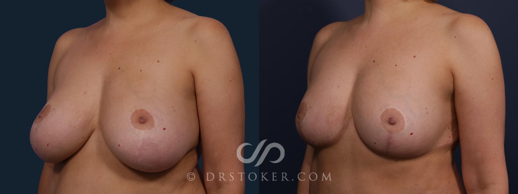 Before & After Breast Reduction (for Women) Case 2060 Left Oblique View in Los Angeles, CA
