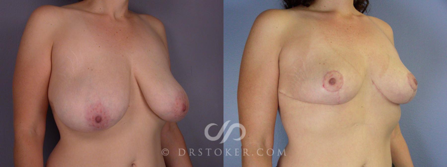 Before & After Breast Reduction (for Women) Case 207 View #2 View in Los Angeles, CA